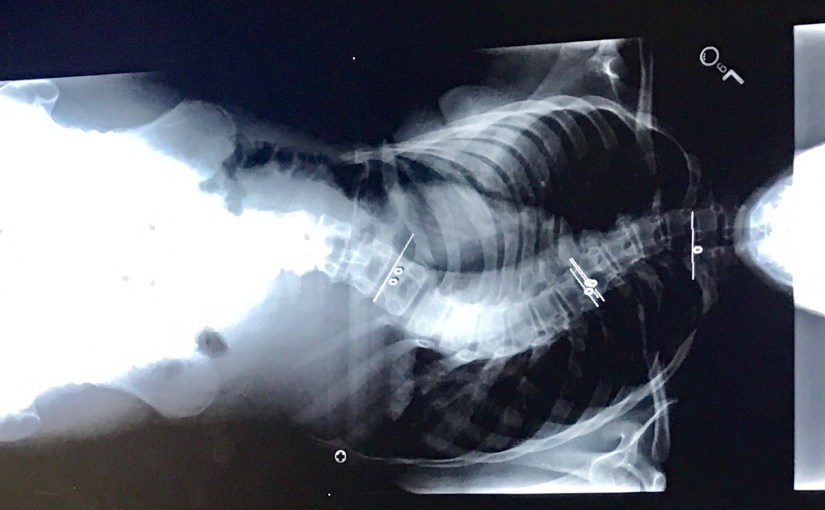 Traveling with Scoliosis